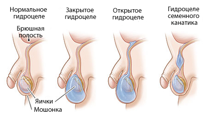 Как водянка влияет на бесплодие?